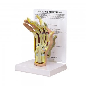 [과학쌤이오] 인체 손 류마티스성관절염 모형 G1931