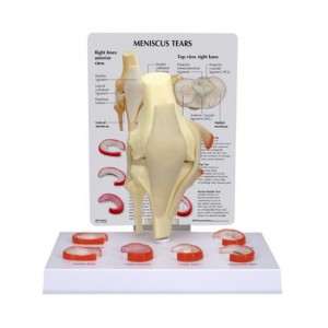 [과학쌤이오] 무릎 관절 반월상연골파열 모형 G1010