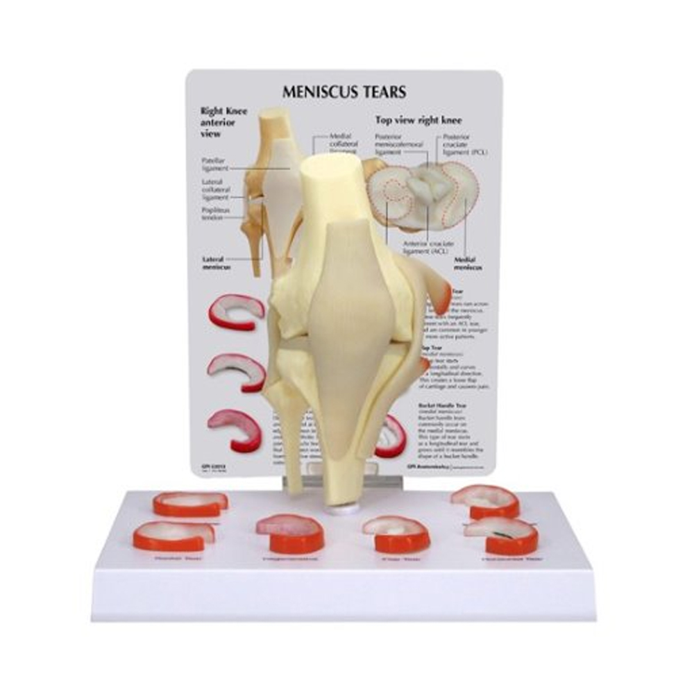[과학쌤이오] 무릎 관절 반월상연골파열 모형 G1010